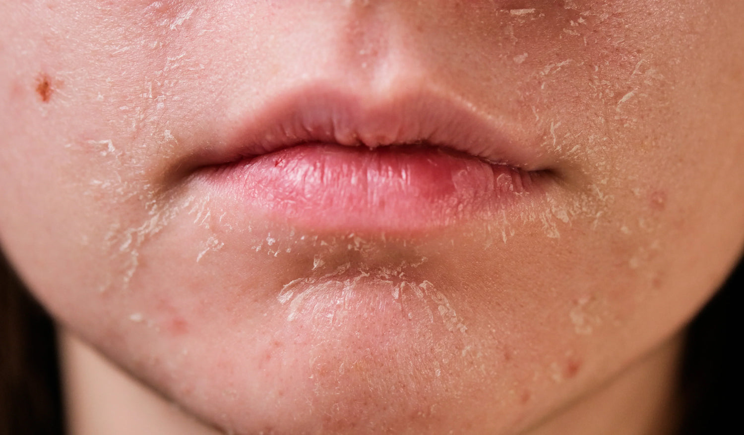 Side Effects of Roaccutane and How to Deal With Them