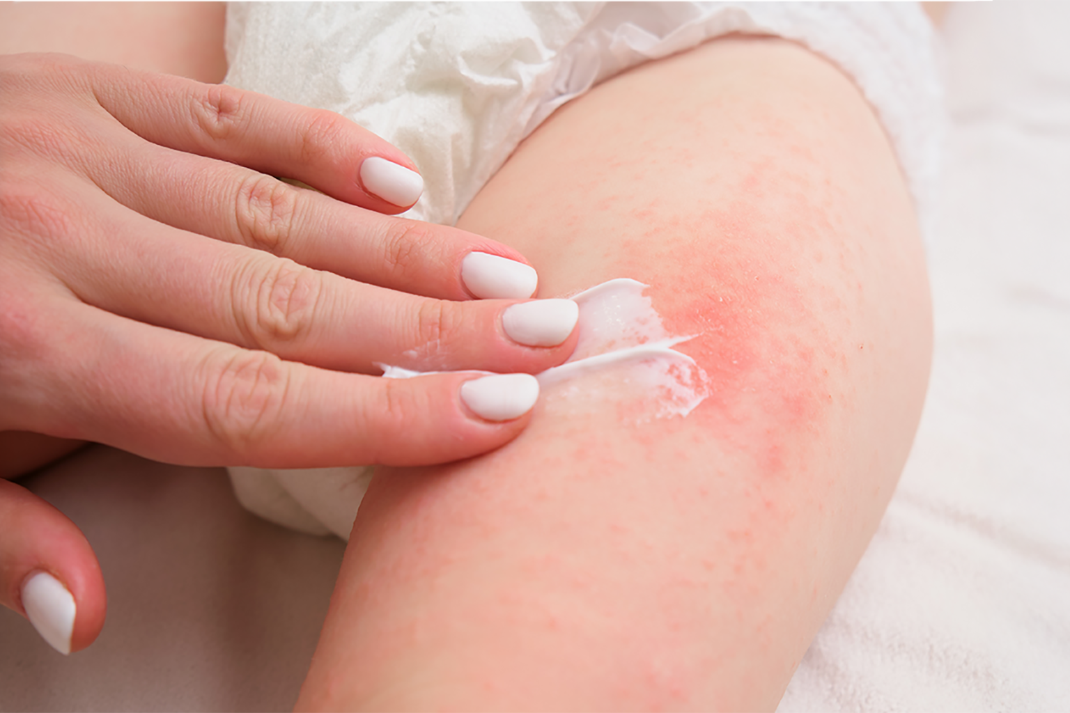 Rash Creams